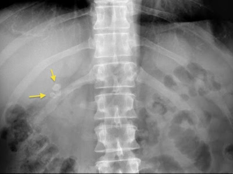 radiografia calcoli cistifellea