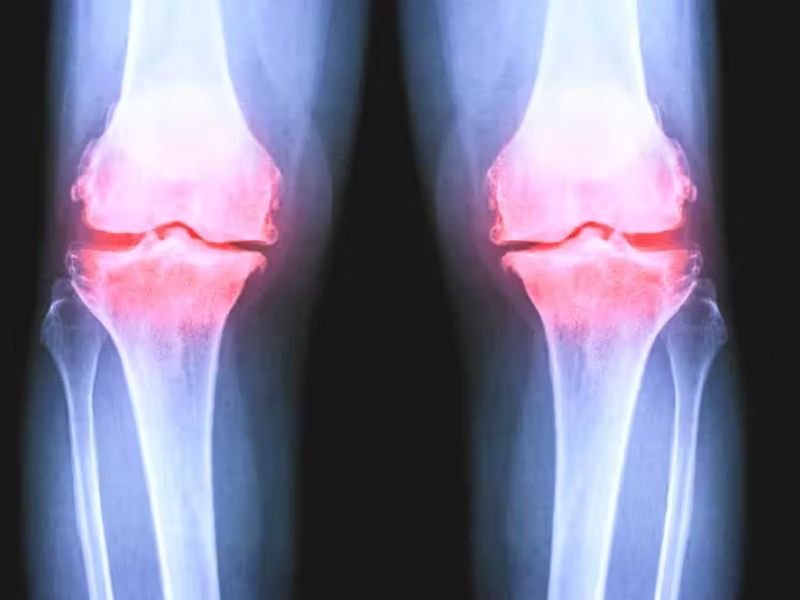 radiografia al ginocchio