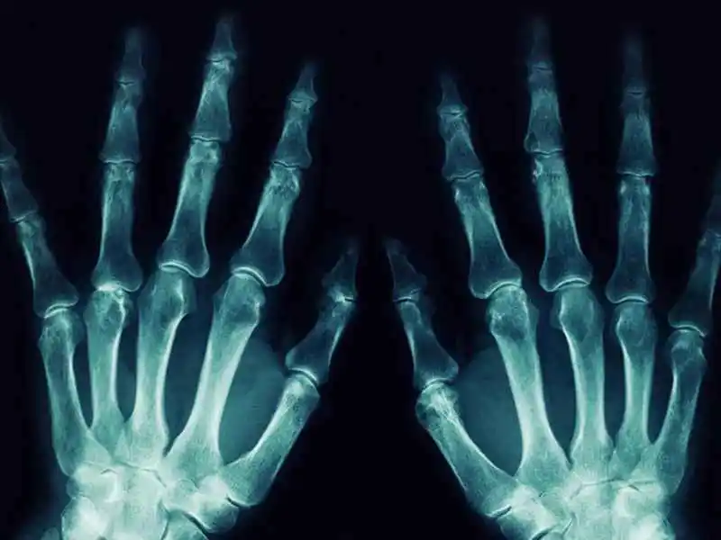 radiografia mano