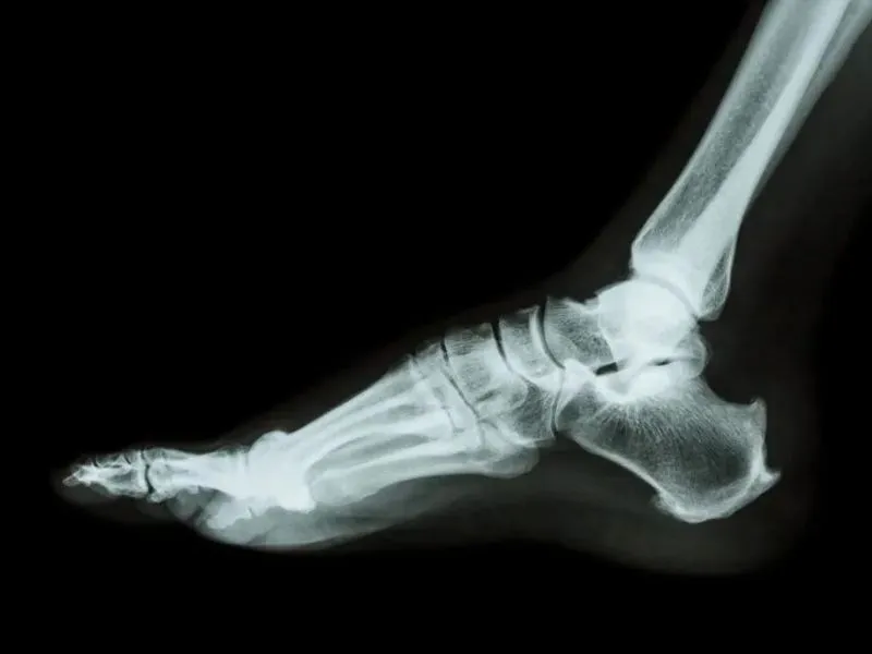 radiografia piede