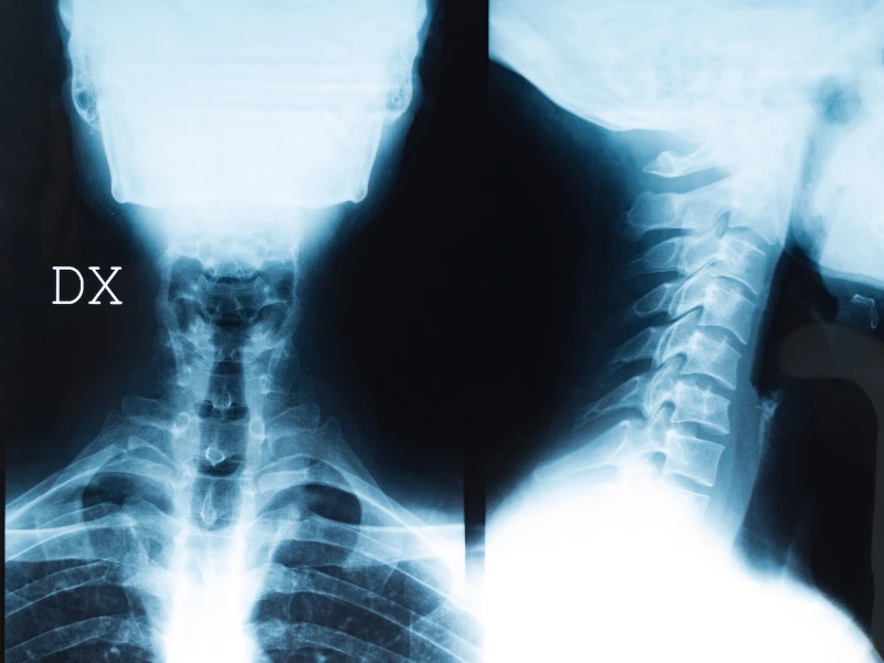 radiografia cervicale