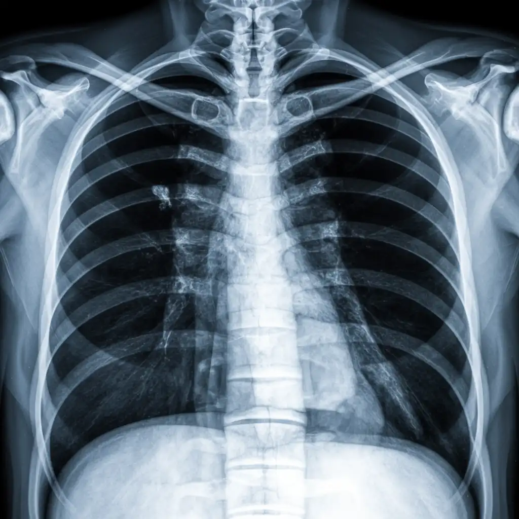radiografia emitorace