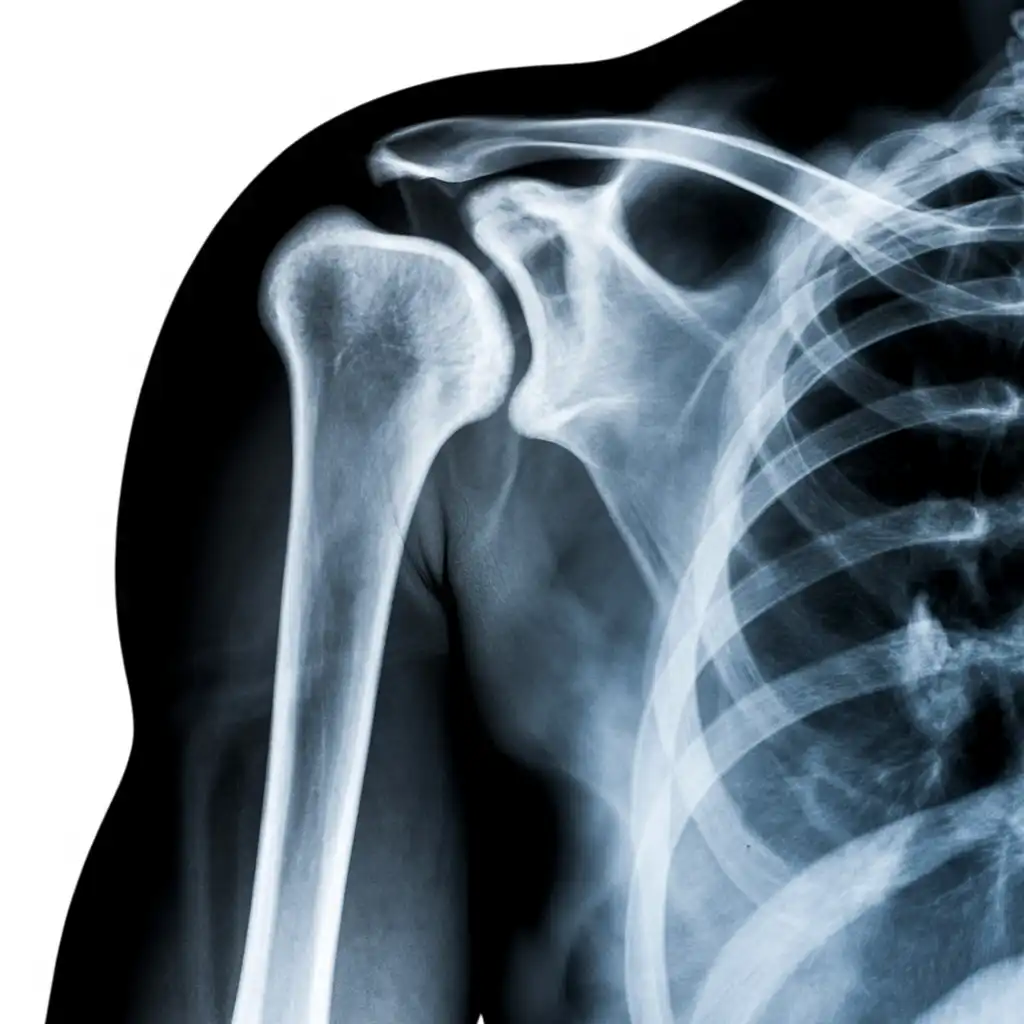 radiografia omero
